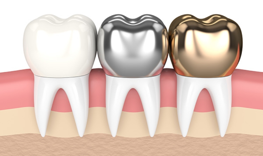 Transform Your Smile With The Power Of Dental Crowns
