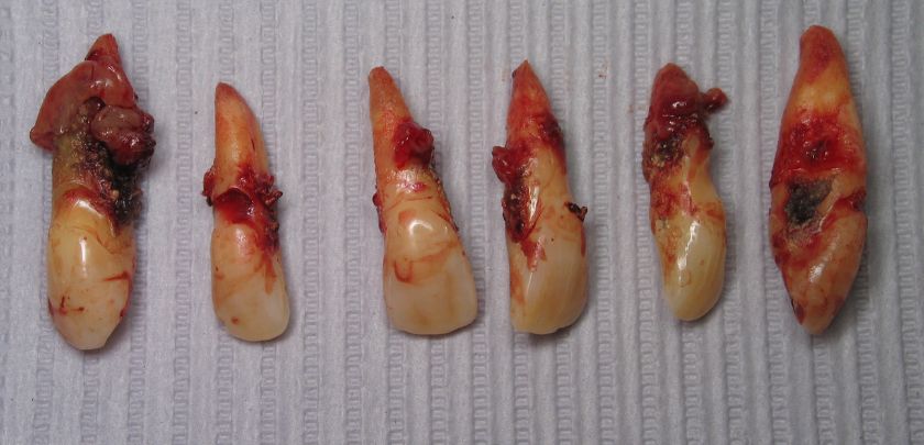 What Happens To The Abscess After Tooth Extraction