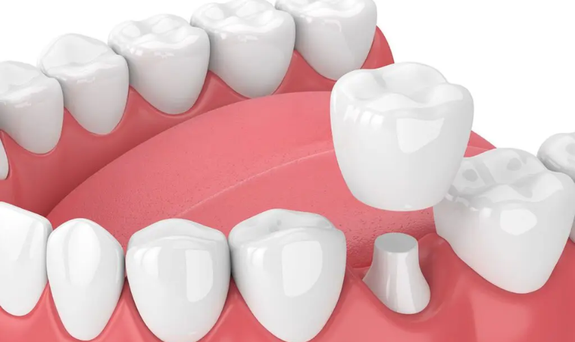 Benefits of Dental Crowns