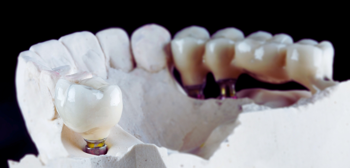 here is why dental bridges are a great solution for missing teeth