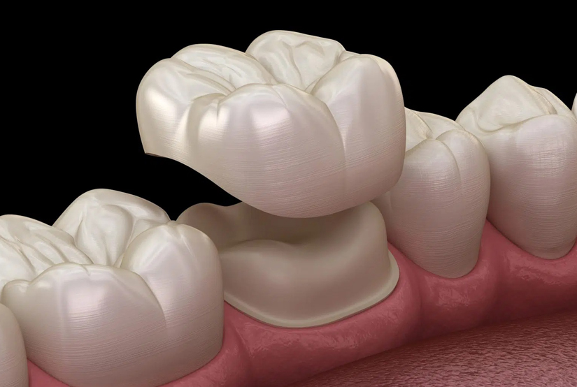 Westinghouse Dental offers Cosmetic Dental Crowns in Georgetown TX
